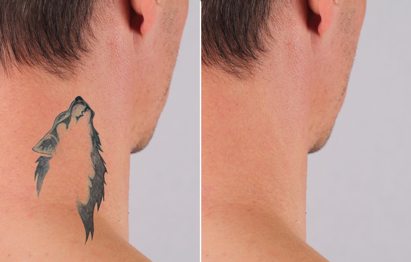 Laser Tattoo Removal in Richmond Hill - Beauty Fairy Clinic